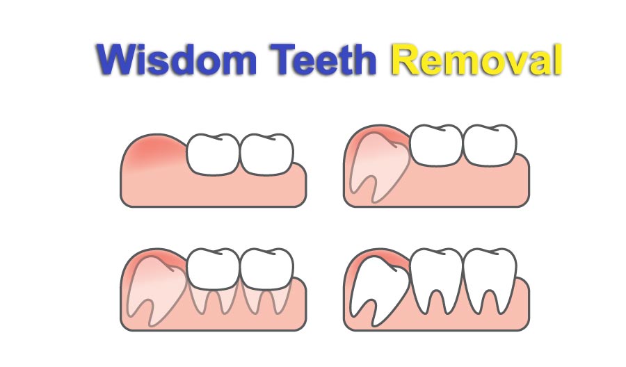  Wisdom teeth removal