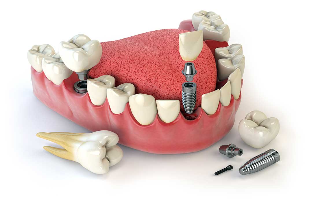 Bone graft after tooth extraction