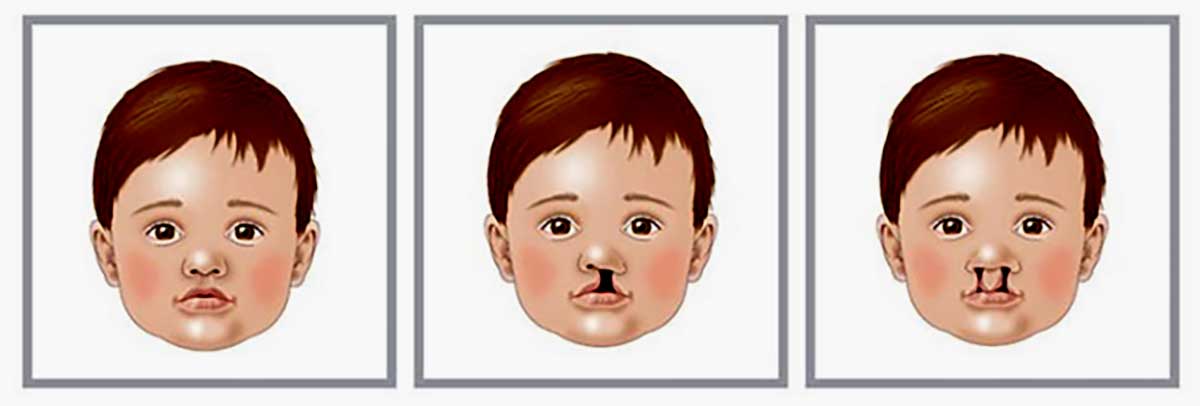 cleft lip and palate adults