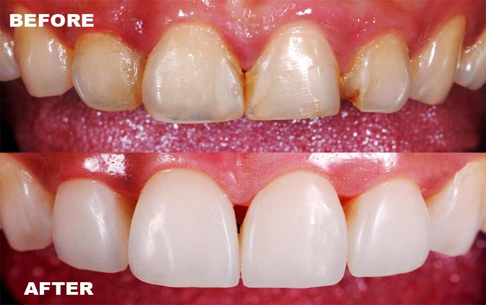 Front Teeth Fillings Before and After