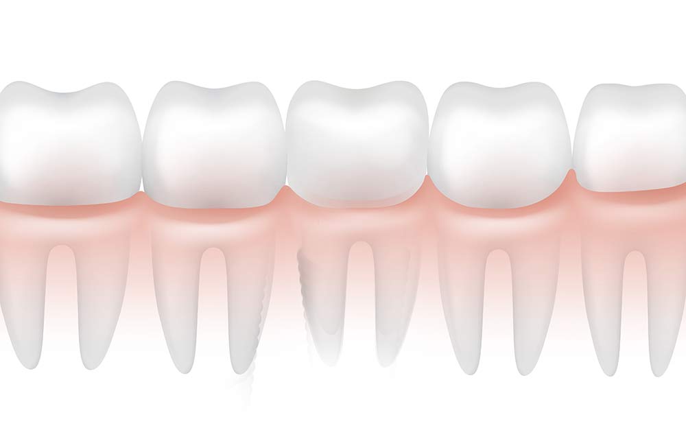 Dental Crown