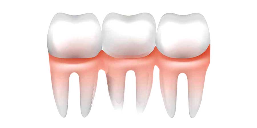 Dental Crowns 