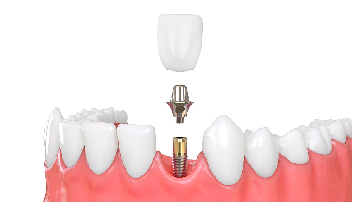 Dental Crowns