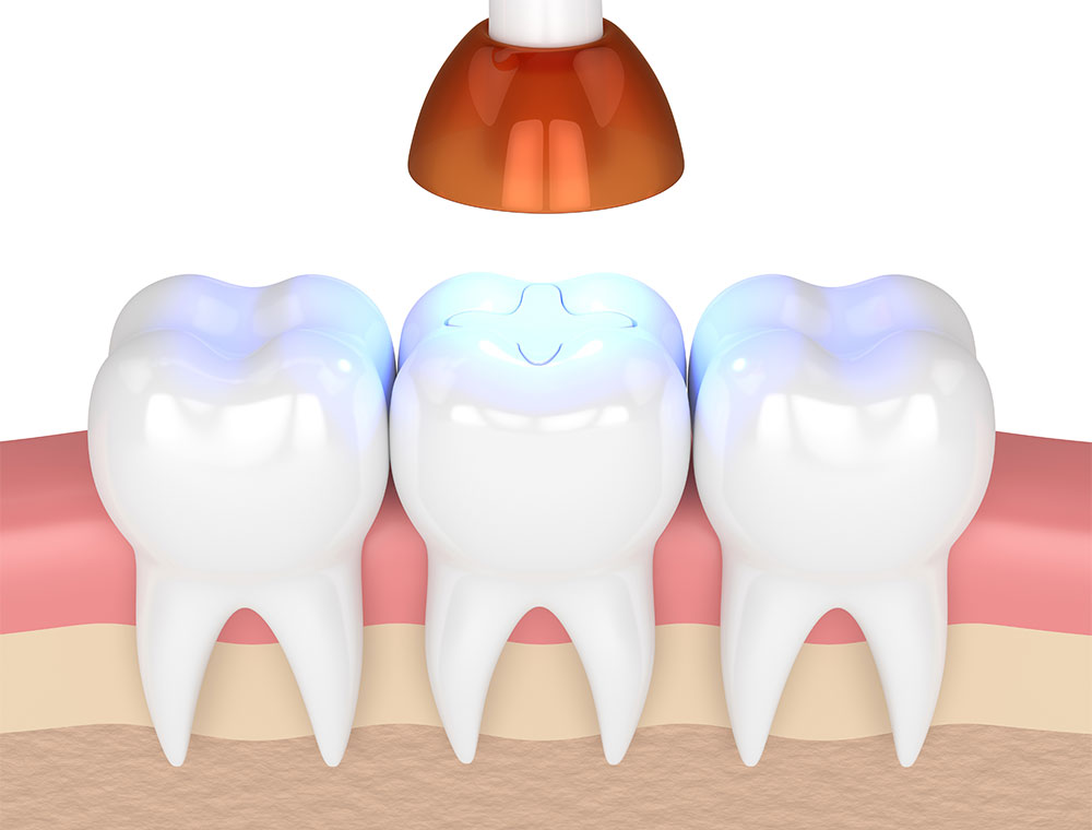 How long do dental crowns last?