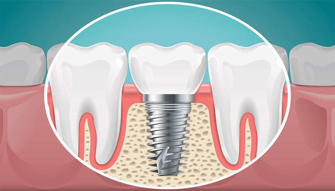 Immediate Dental Implant