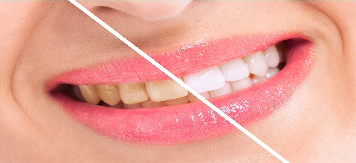 Importance of healthy smile