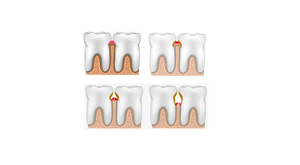 Periodontics 