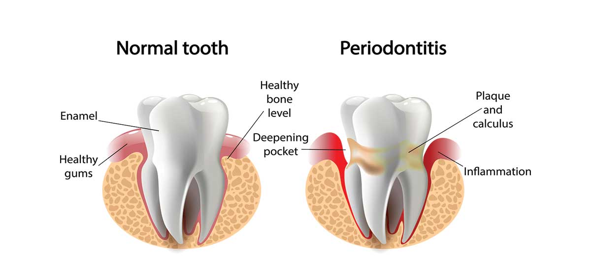  Periodontitis Symptoms