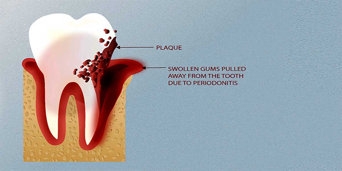 Ask a Periodontist - How Can Gum Disease Harm Your Teeth and Jawbone?