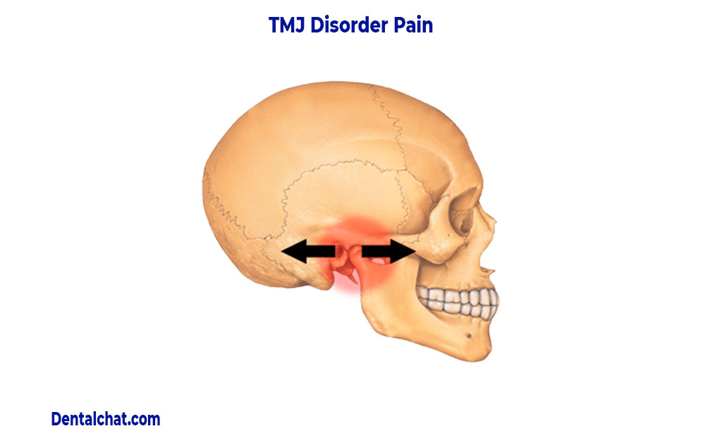 TMJ TMD DISORDER