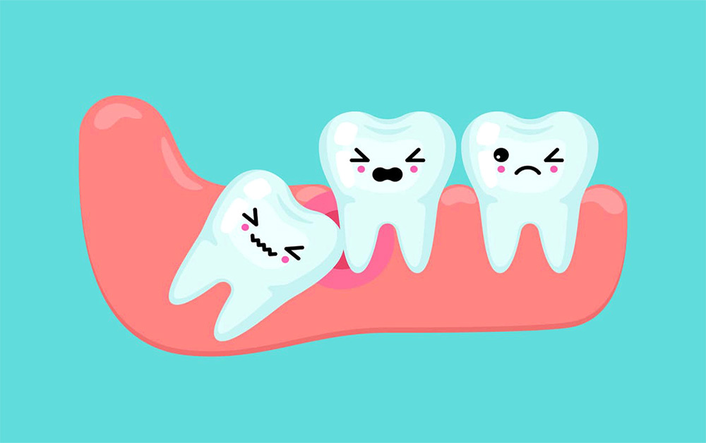 Third Molars Extraction (Wisdom Tooth)  