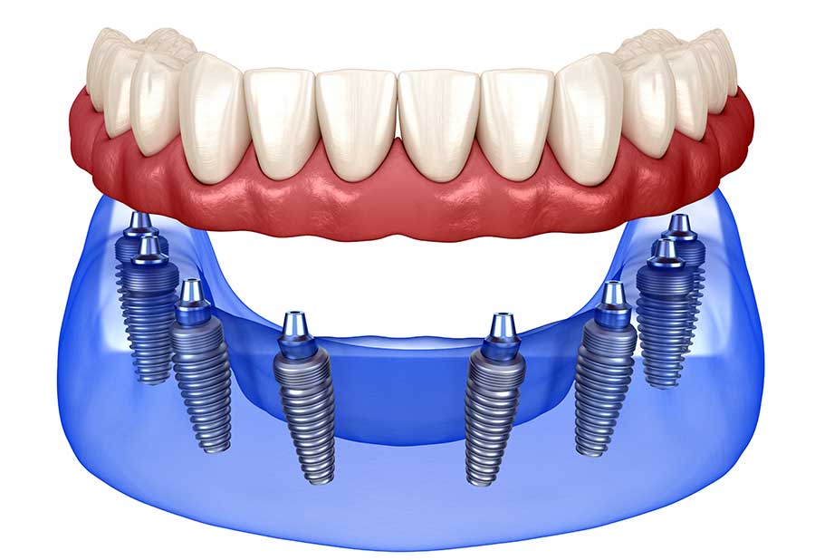 Why Dental Implants Sometimes Fail