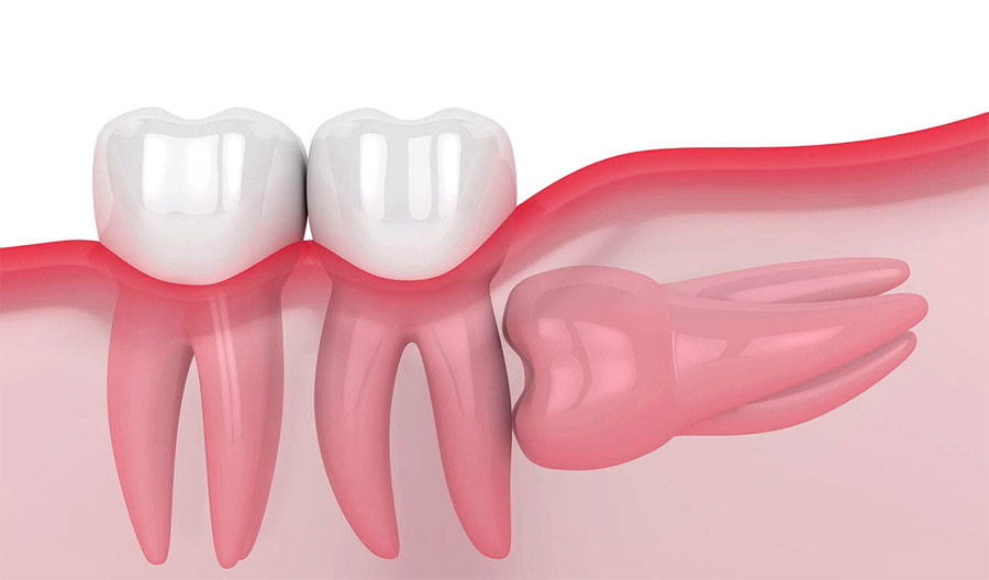 Wisdom Tooth Extraction