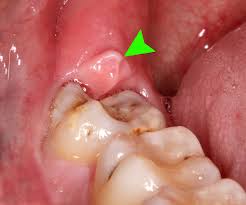 Tooth Abscess Problem Question, Wisdom Teeth Problems Chatting, Dental Care Help for tooth infection