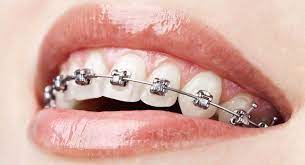 Getting Braces Chat online, Orthodontist Treatment Info