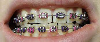 Local Braces Chat, Orthodontics Treatment Discussion & Online Invisalign Blog
