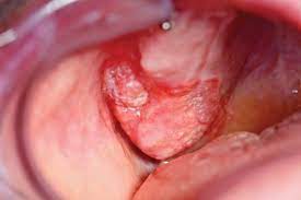 Oral Cancer Chat, Mouth Cancer Treatment Blog Online and mouth cancer blogging online.