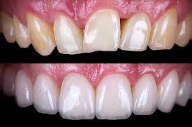 Dental Veneers Information, Cosmetic Dental Veneers Chat, Local Cosmetic Dental Veneer Blog, Dental Veneers Blogging