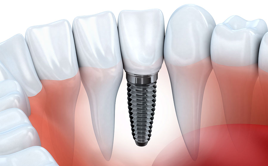 failing dental implant