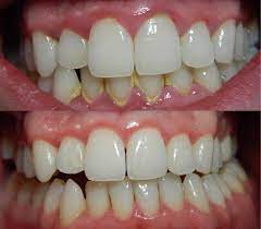 What is Gingivitis? Gingivitis Chat Online,  Periodontal Gum Disease Blog, Dental Gingivitis Questions and Online Oral Hygiene Chat