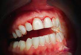 What is Gingivitis? Gingivitis Chat Online,  Periodontal Gum Disease Blog, Dental Gingivitis Questions and Online Oral Hygiene Chat