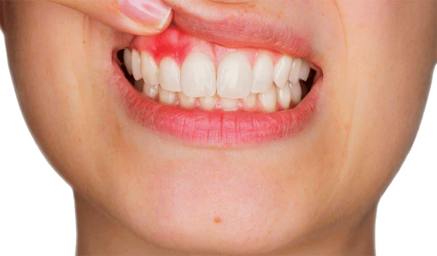 tooth abscess