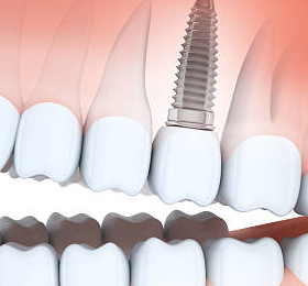 online dental implants question chat
