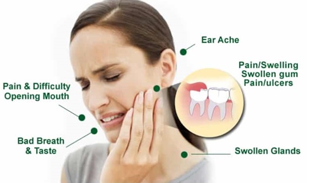 wisdom teeth blog, third molar chat